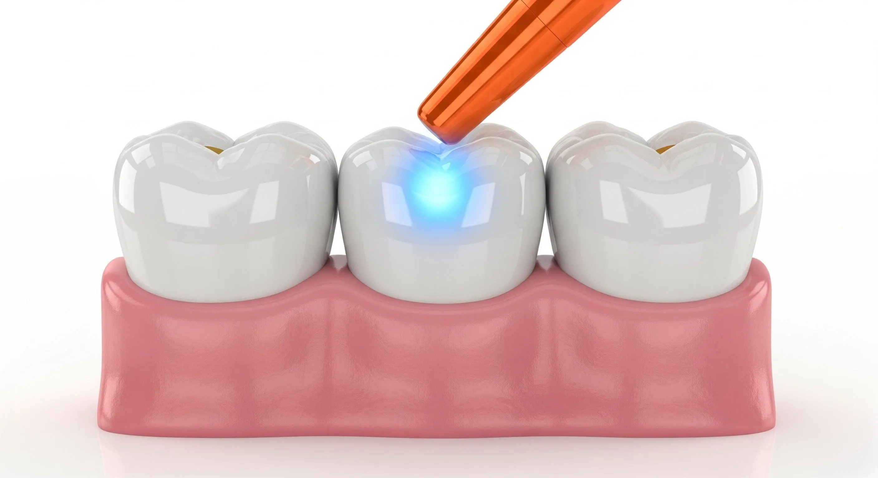 Composite Fillings Cost and Pricing Information in San Antonio