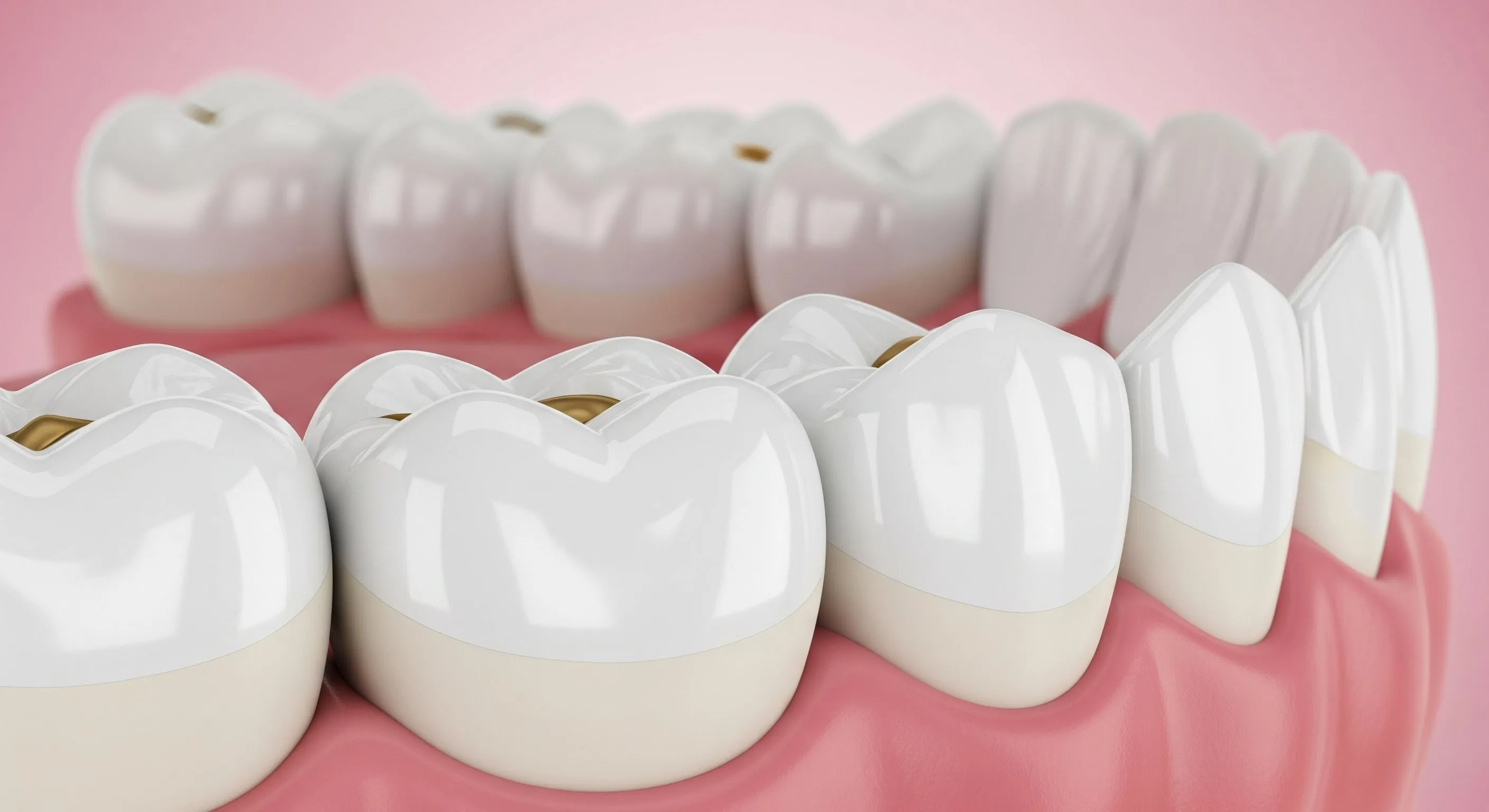 What Are Dental Sealants